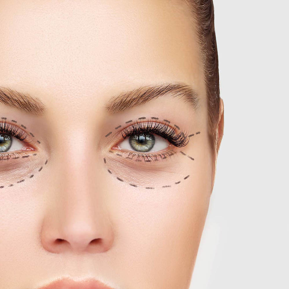 Blepharoplasty / Eye Bag Removal