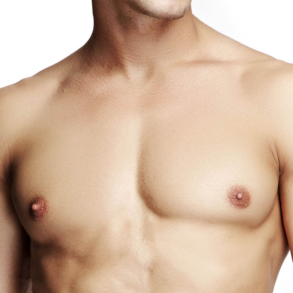 Male Breast Removal / Gynaecomastia Treatment