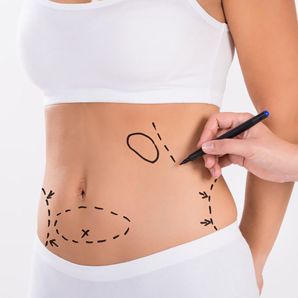 Liposuction