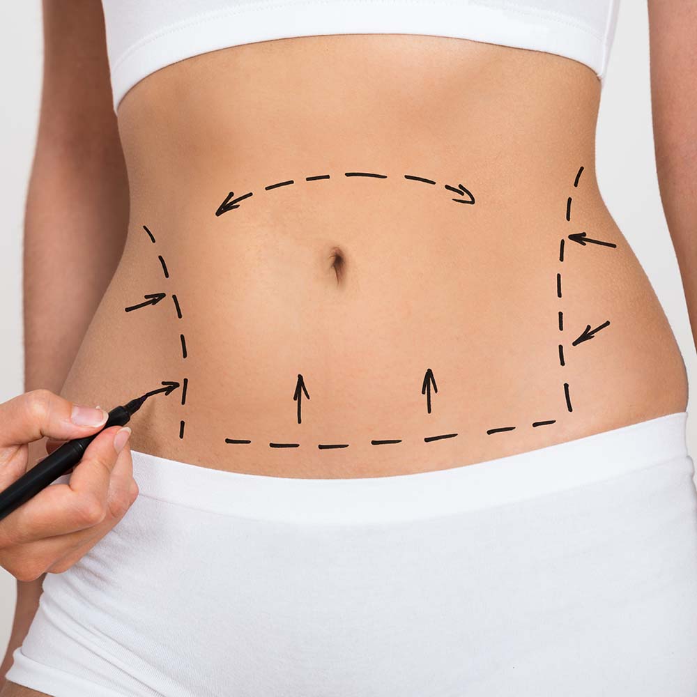 Tummy Tuck / Abdominoplasty